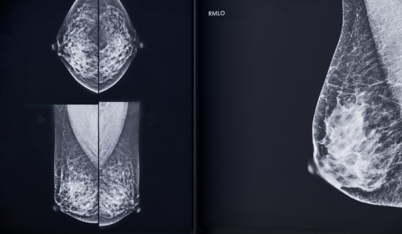 Extremadura responde con rigor y transparencia al requerimiento de Sanidad con el envío de datos de cribado