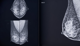 Extremadura responde con rigor y transparencia al requerimiento de Sanidad con el envío de datos de cribado